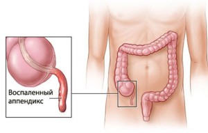 воспалённый аппендикс