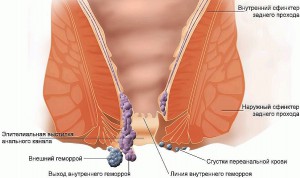 симптомы геморроя